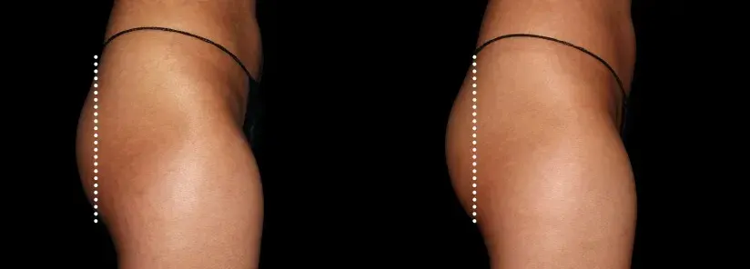 Emsculpt Neo before and after