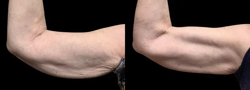 Emsculpt Neo before and after