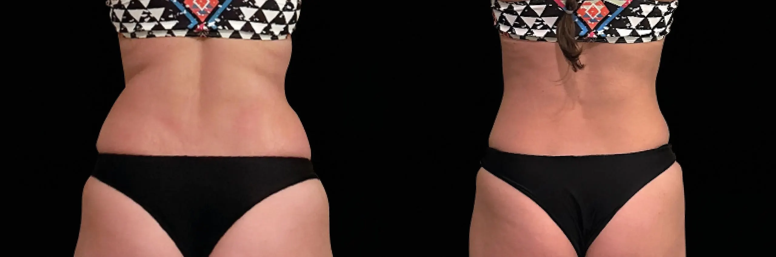 Emsculpt Neo - Before and After